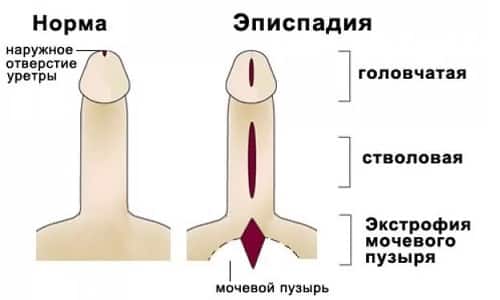 Аномальное строение мочевыводящих путей называется эписпадией
