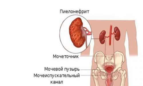 Независимо от формы цистита рецидив способен привести к такому заболеванию, как пиелонефрит
