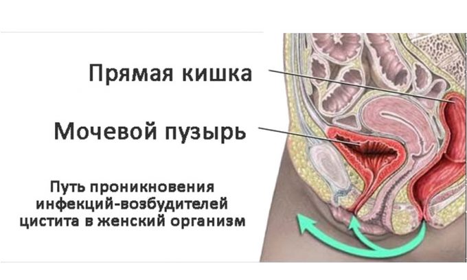 Особенности строения моче-половой сферы делают женщин более подверженными циститу