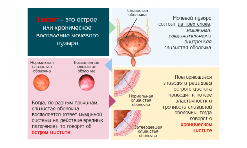 Хронический цистит имеет длительное вялотекущее течение и сопровождается периодическими рецидивами