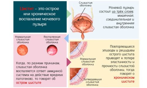 Острый цистит чаще диагностируется у женщин из-за особенностей строения мочеполовой системы