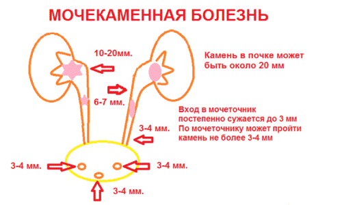 Причины мочекаменной болезни (МКБ) могут быть экзогенными и эндогенными. Чем больше причин вызывают заболевание, тем тяжелее лечить его