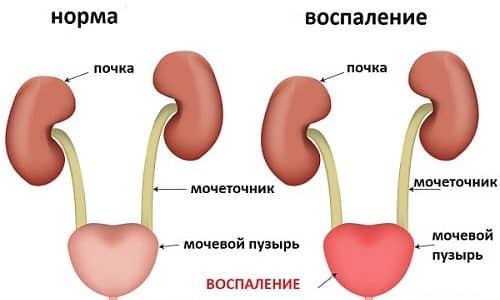 Цистит представляет собой урологическое заболевание, вызывающее воспалительные процессы и патологические изменения в мочевом пузыре человека