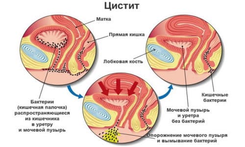 Цистит - это воспалительный процесс, который протекает в мочевом пузыре