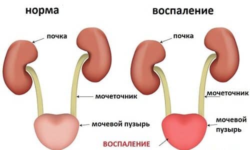 Медики рекомендуют принимать уросептики, которые оказывают губительное воздействие на патогенную микрофлору воспаленных органов