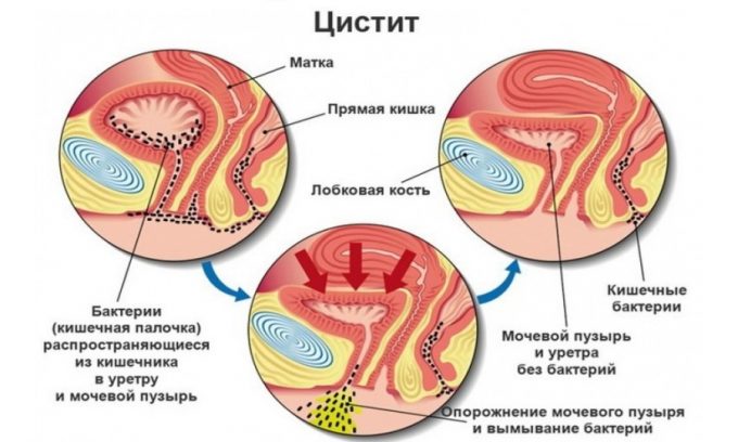 Строение мочевыводящей и половой систем девочек обуславливает их предрасположенность к циститу
