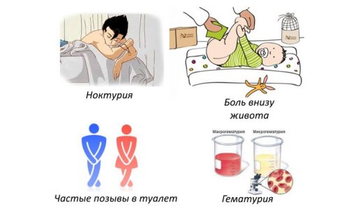Симптомы цистита у детей