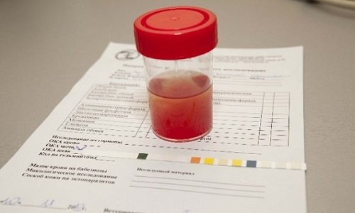 Кровь в моче сигнализирует о проблемах мочеполовой системы