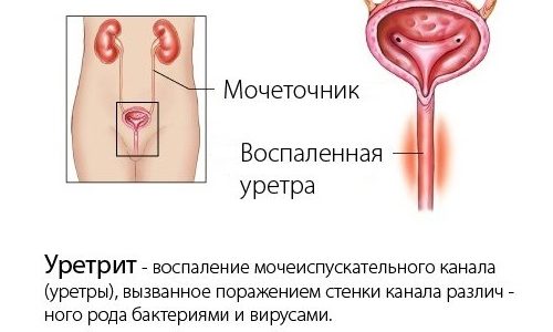 Дискомфорт при мочеиспускании может говорить об уретрите