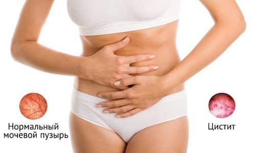 Цистит у женщин — распространенная патология, характеризующаяся развитием воспалительного процесса в мочевом пузыре