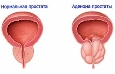 аденома простаты