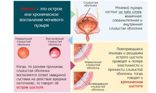 Цистит опасен тем, что при отсутствии правильного лечения заболевание из острой формы может перейти в хроническую
